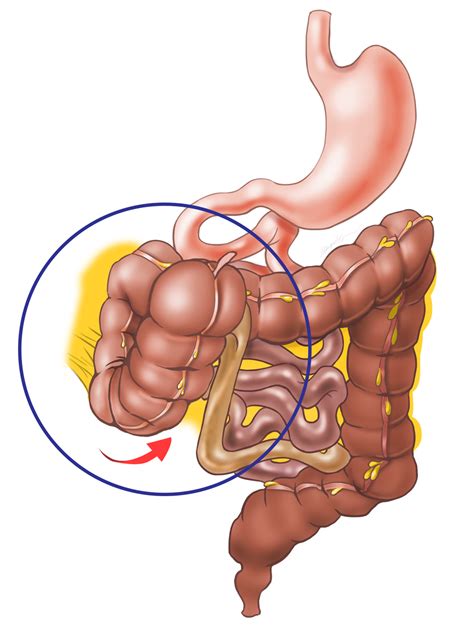 Abnormalities of the Cecum :: Behance