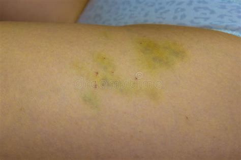 457 Bruise Scratch Stock Photos Free And Royalty Free Stock Photos From