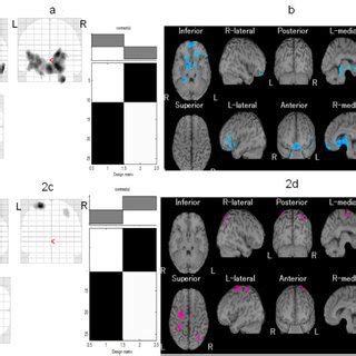 Comparison Of Regional Cerebral Blood Flow RCBF Between The Responder