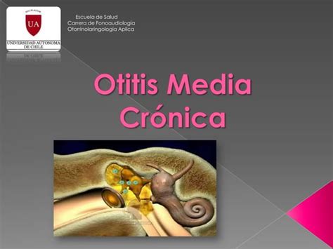 Otitis Media Cr Nica Ppt