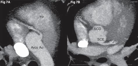 SciELO Brasil Coronary Anomalies What The Radiologist Should Know