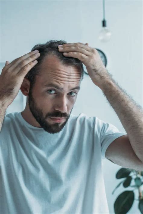 Por qué a los hombres se les cae el cabello Hablemos de Belleza