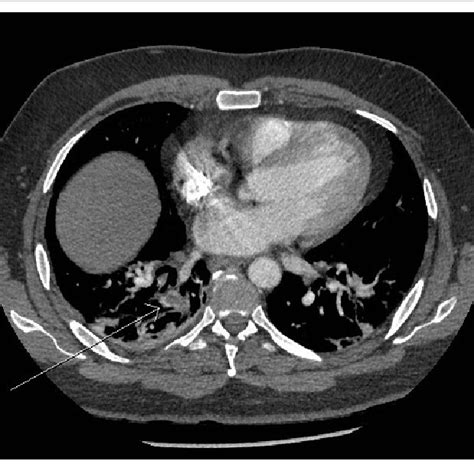 Computed Tomography Angiography Showing A Pulmonary Embolism