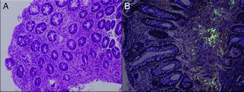 A Hematoxylin And Eosin Staining Of Rectal Biopsy Showing Focal Download Scientific Diagram