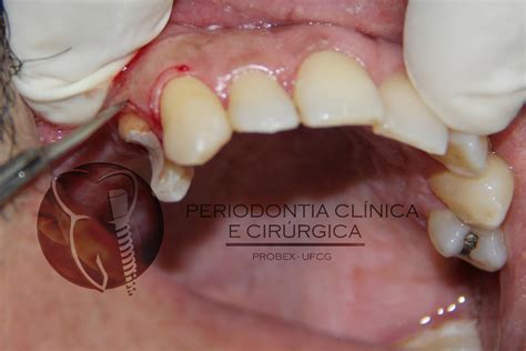 Aumento De Coroa Cl Nica Osteotomia Para Restabelecimento Das