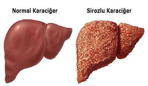 Siroz Hastal Nedir Nedenleri Belirtileri Ve Tedavisi Bilgigo