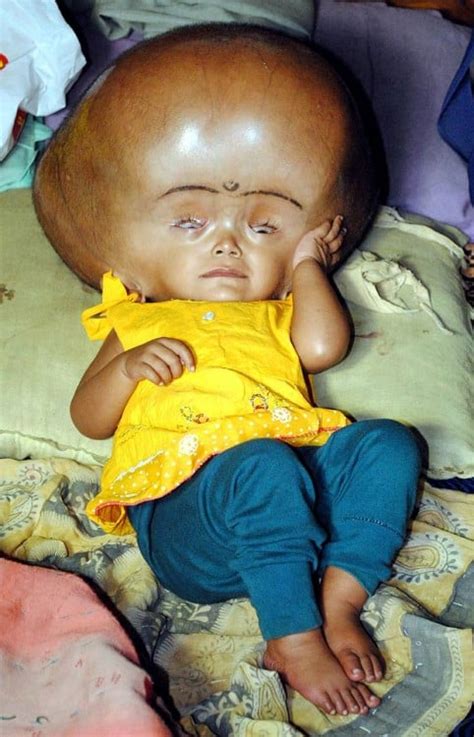 Baby from India with Severe Hydrocephalus Discharged This Week from ...