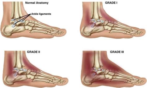 Ankle Sprains | East Africa Orthopaedics