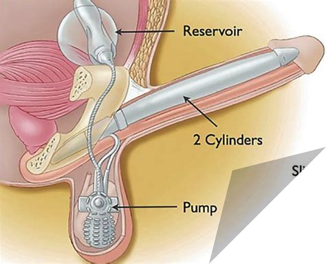 Penile Implant Purpose Procedure Risks Recovery 47 OFF