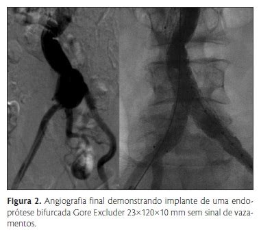 SciELO Brasil Relato de caso de tratamento endovascular de fístula