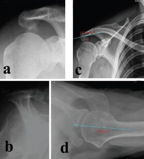 Supraspinatus Outlet View Shoulder X Ray Sema Data Co Op