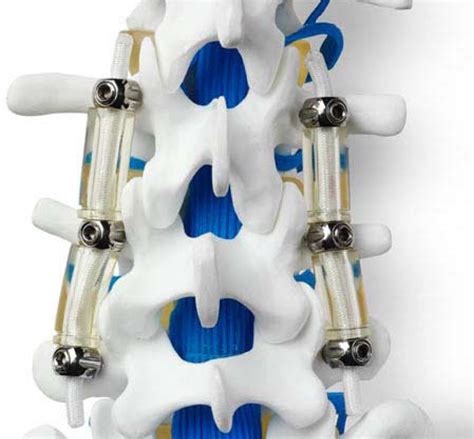 Biomechanical Evaluation Of Pedicle Screw Based Dynamic Stabilization