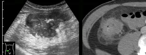 Crohn's Disease Ultrasound