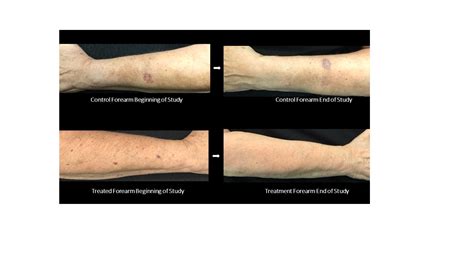 Dr. Siperstein Studies New Treatment for Forearm Bruising - Siperstein ...