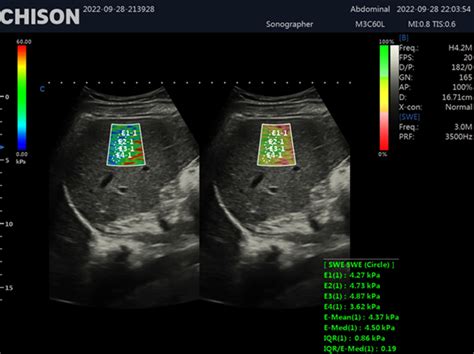 Shear Wave Elastography In Ultrasound A Breakthrough In Diagnostic Imaging