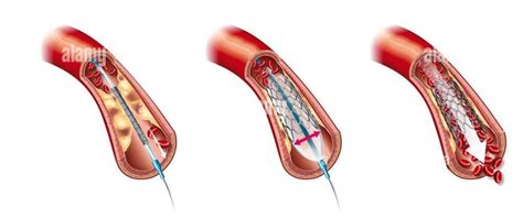 Daily Routine After Angioplasty Dr Atul Kasliwals Blog Cardiology