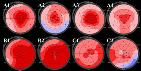 Relative Apical Sparing Of Longitudinal Strain Using Two Dimensional