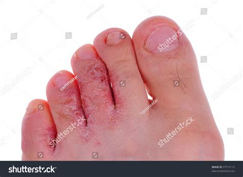 Athlete'S Foot Stock Photo 37715113 : Shutterstock