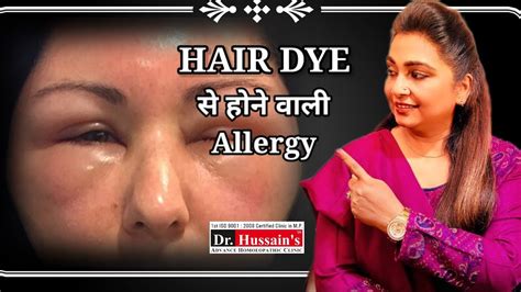 हेयर कलर से एलर्जी होने पर क्या करें Hair Colour Se Allergy Ka Ilaj Drhussains Greyhair Youtube