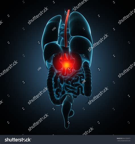 Disease Illustration Human Stomach Stock Illustration 361322672 ...