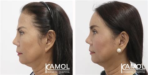 Forehead Implant Kamol Cosmetic Hospital