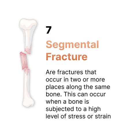 7 Types Of Bone Fractures Orthopaedic Surgeon Durban