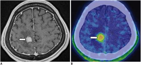 Imaging Spectrum And Pitfalls Of C Methionine Positron Emission