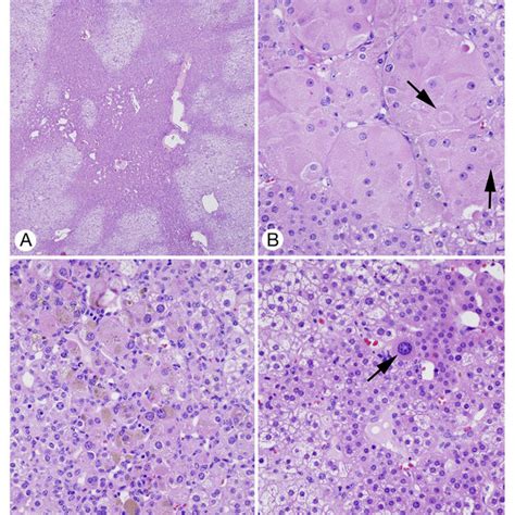 Adrenocortical Adenoma A Clear Cells And An Irregularly Shaped Zone Download Scientific