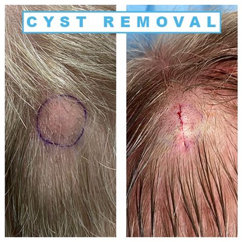 Epidermoid Cysts On Back