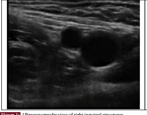 Figure 1 From Nerve Stimulator Versus Ultrasound Guided Femoral Nerve Block A Randomized