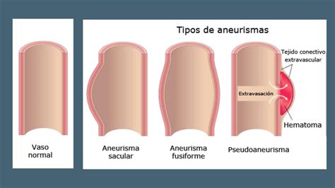 Solution Resumen Aneurisma Y Disecci N Studypool