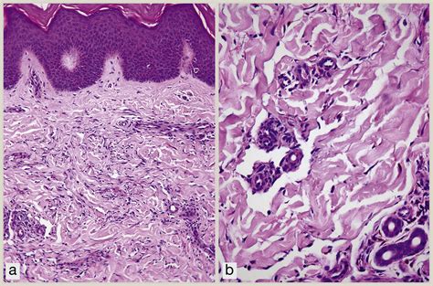 Cutaneous Kaposi Sarcoma And Its Mimics Diagnostic Histopathology