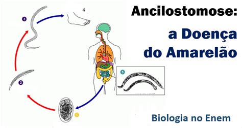 O Que É Ancilostomose - Ancilostomose: a doença do Amarelão. É Biologia no Enem