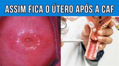 Como fica o útero após a CAF cirurgiadealtafrequência YouTube