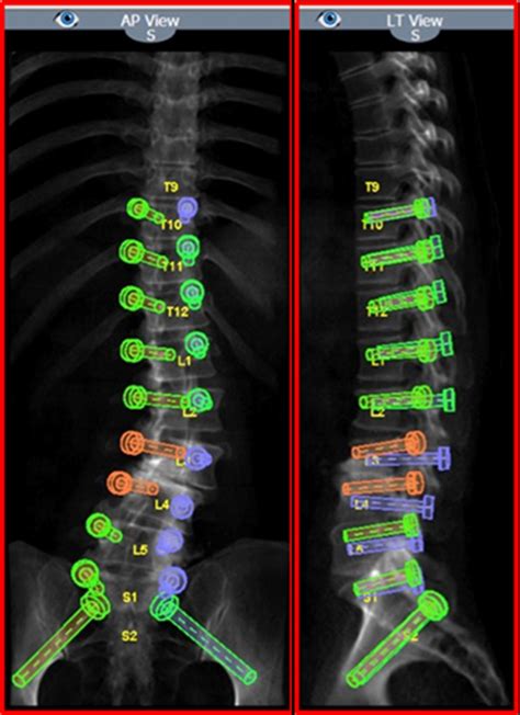 Robotics For Revision Spine Surgery Neupsy Key