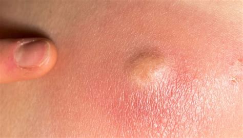 Sebaceous Cyst Bikini Line
