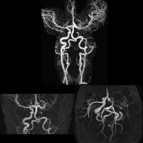 moyamoya syndrome | pacs