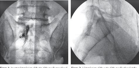 Comparison Of Epidural Steroid Injection Between L5 S1 Retrodiscal Technique And S1