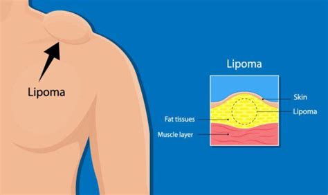 Best Home Remedies For Lipoma