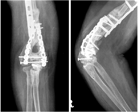 Anteroposterior Translateral Radiographs Of The Right Elbow Months