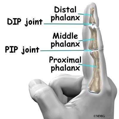 Artificial Joint Replacement of the Finger - eOrthopod.com