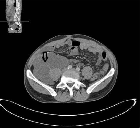 Pseudomyxoma Peritonei Due To Ruptured Appendiceal Mucocele Eurorad