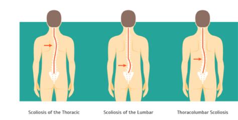 Scoliosis Symptoms