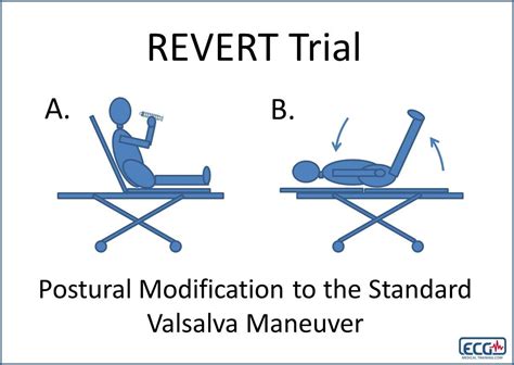 Modified Valsalva Maneuver For Svt The Emergency Medical Minute