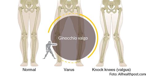 Ginocchio Valgo Guida Avanzata Sintomi Cura E Fisioterapia