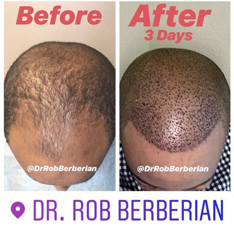 Best Hair Transplant Doctor Los Angeles Newport Beach Orange County Dr. Rob Berberian