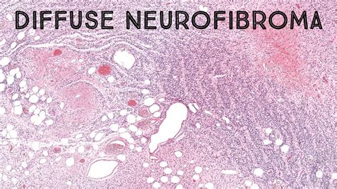 Diffuse Neurofibroma In Neurofibromatosis Nf Round Nuclei Tiger