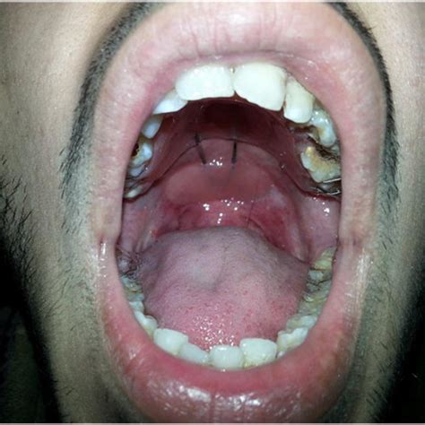 Palatal Lift Appliance In Position Download Scientific Diagram