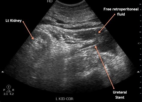 Retroperitoneal hematoma – NephroPOCUS