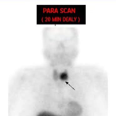 A Early Anterior Planar Image Of Technium 99m Sestamibi Scan